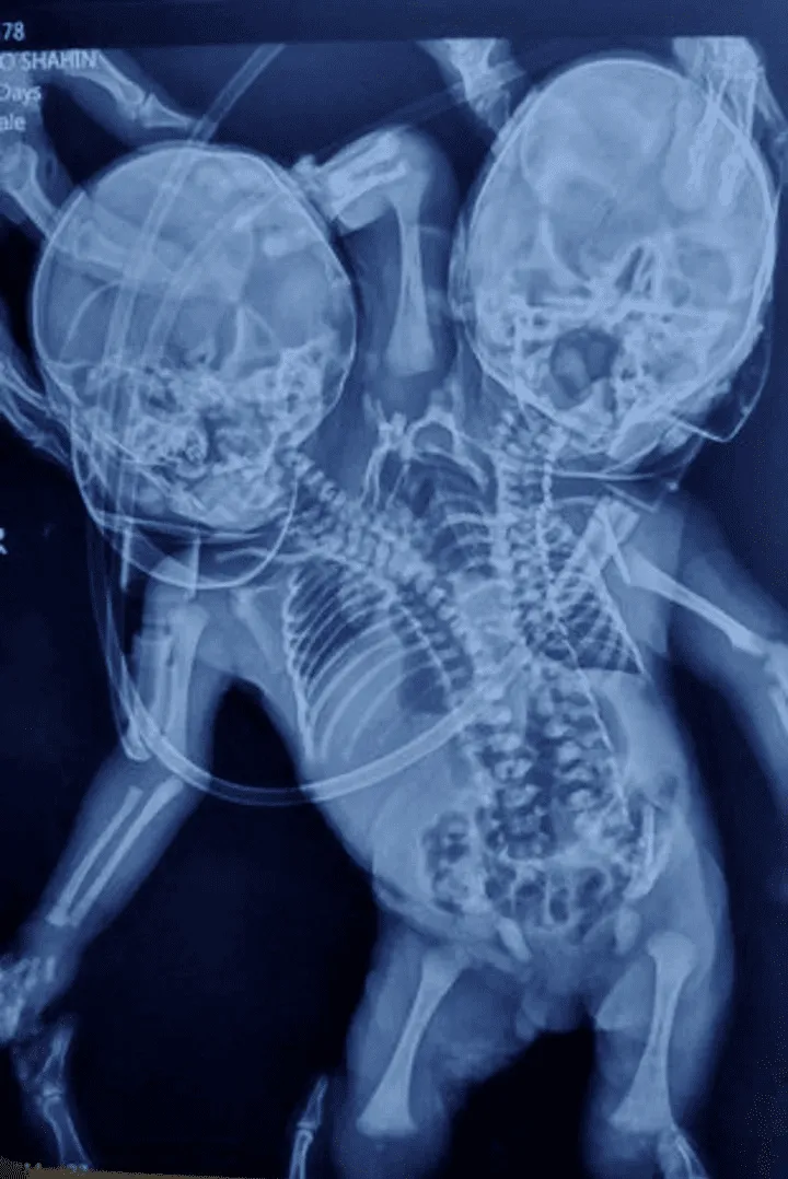 en-la-imagen-radiografia-de___exgn3kp7e_720x0__1_crop1648748676603.png_397855632