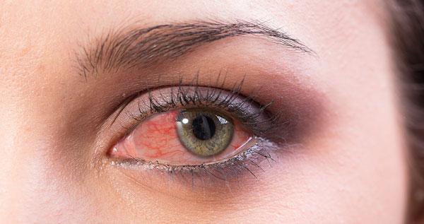 zamarripa-opticos-salud-visual-auditiva-Sindrome-Sjogren-DESTACADA-1