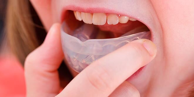 Mouthguards-