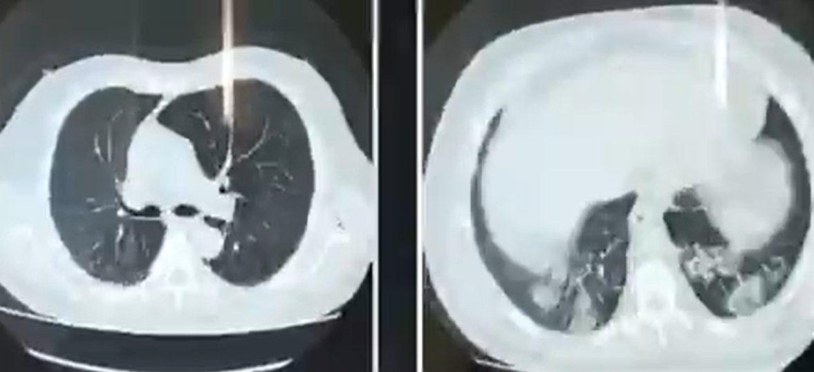 pulmones-covid