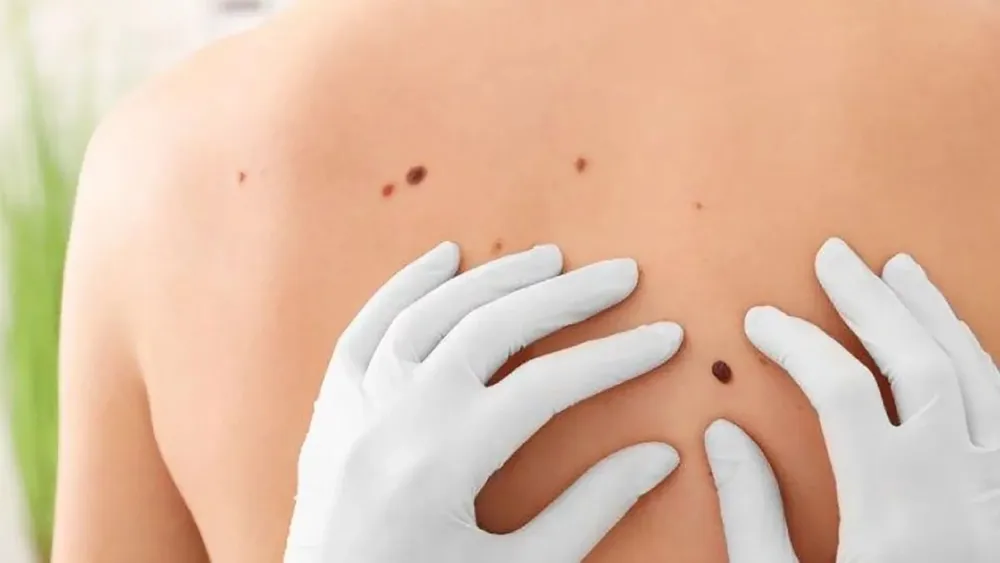 Melanoma Más de 1.600 casos diagnosticados anualmente en Argentina